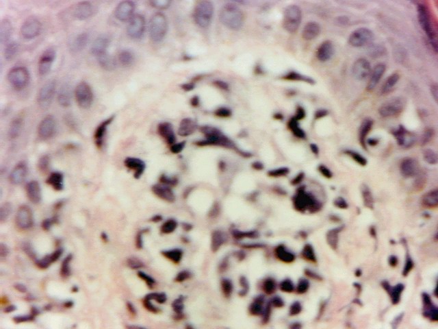 Fig. 4: ATLL, Biopsia cutnea. H-E - <div style=